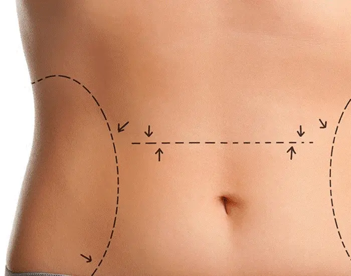 لیپوساکشن و لیپکتومی