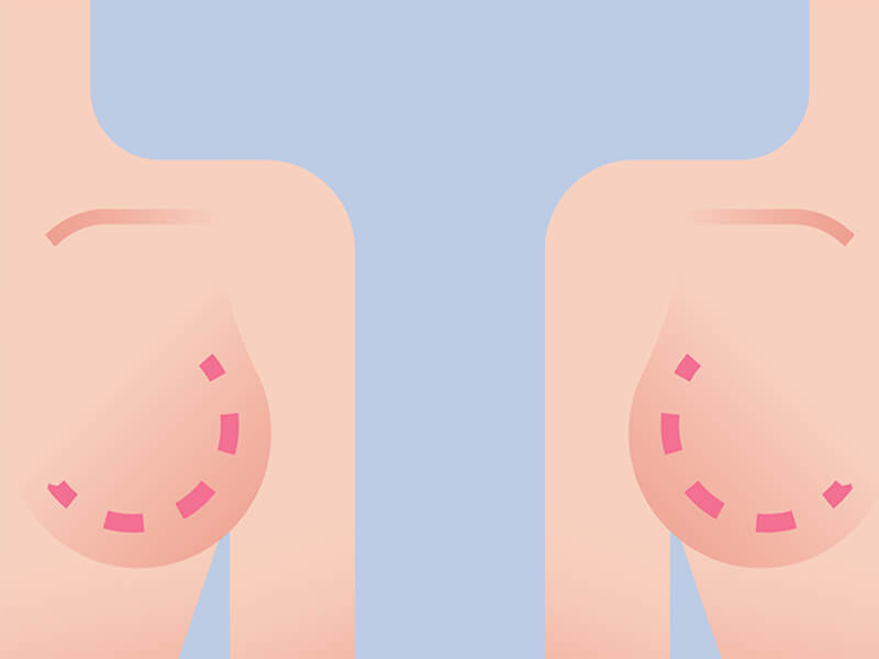 ماموپلاستی (کوچک کردن سینه)