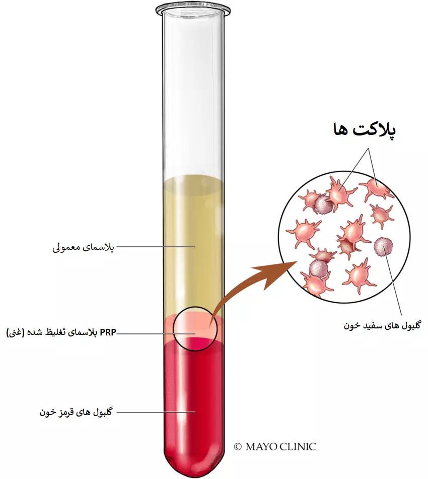تصویر میکرونیدلینگ
