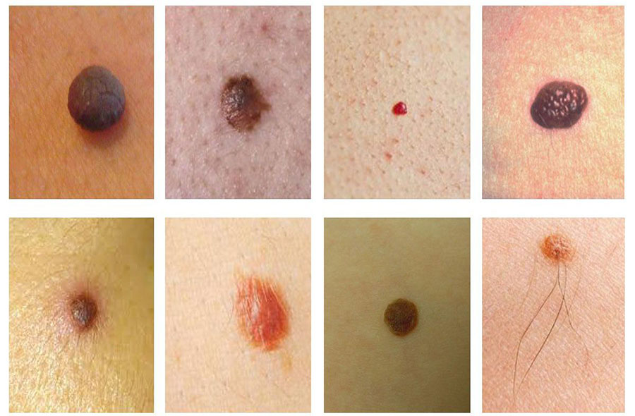 برداشتن میخچه، زگیل و خال بدون درد و خونریزی